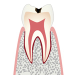 C1・エナメル質の虫歯