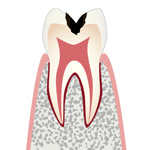 C2・象牙質の虫歯