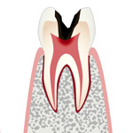 C3・神経まで侵された虫歯