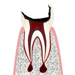 C4・歯冠が崩壊した虫歯