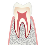 Co・初期の虫歯
