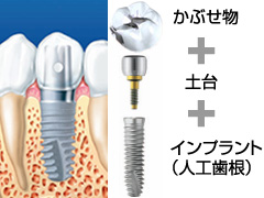 インプラントの構造
