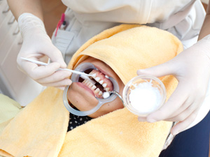 歯質を強くするFAPホワイトニング