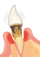 重度歯周病の状態